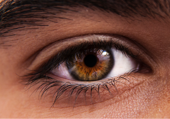 Dry Eye Image